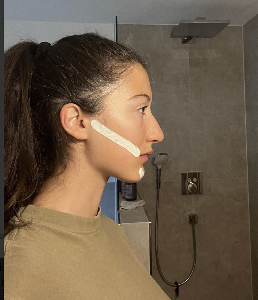 Real results - woman, right profile, wearing ZygoTape