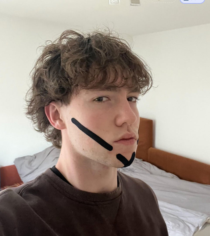 Real results - young man, three-quarter view, jawline after ZygoTape