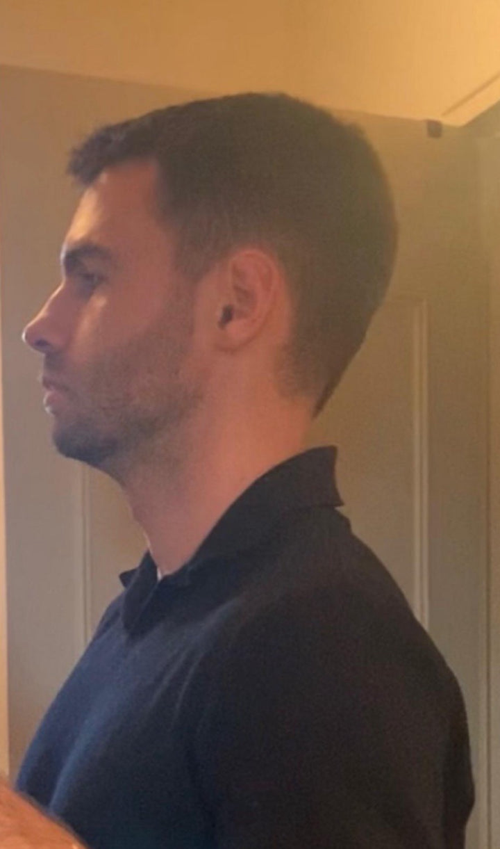 Downward-grown face: narrow palate, recessed chin and longer mid-face
